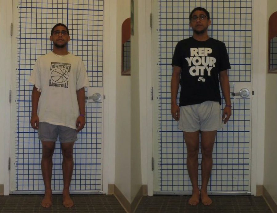 Perubahan pasca melakukan prosedur limb-lengthening (Foto: BBC News)