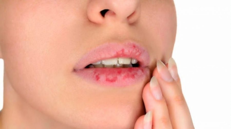 Mengatasi Bibir Kering